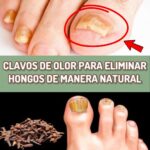 Cómo Eliminar los Hongos en las Uñas con Clavos de Olor: Remedio Natural Efectivo