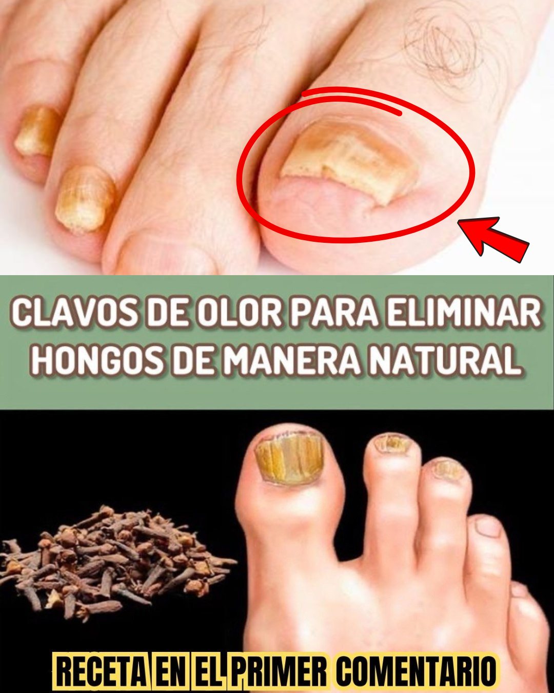 Hongo en las Uñas