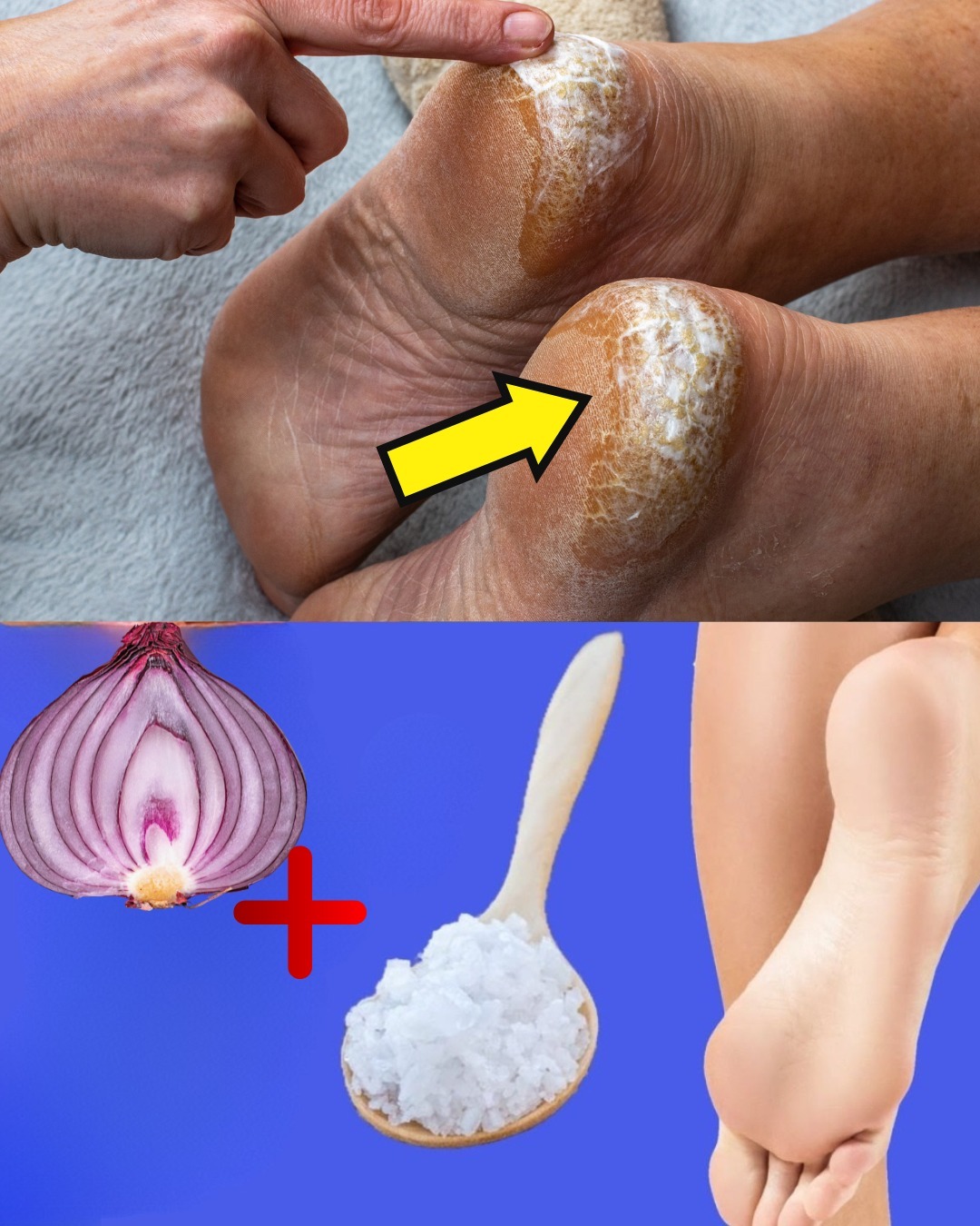 Talones agrietados y remedios caseros