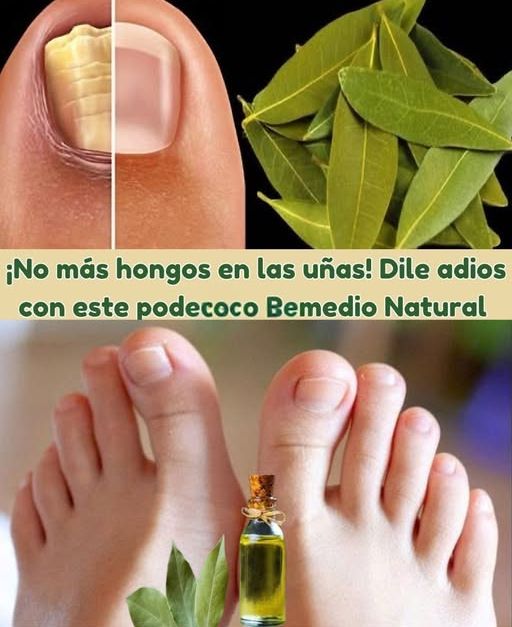 Antes y Después del Tratamiento Natural para Hongos en las Uñas