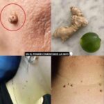 Cómo Eliminar Verrugas de Forma Natural con Jengibre y Limón