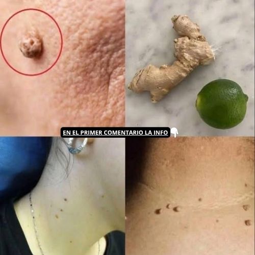 Tratamientos caseros para verrugas con jengibre y limón