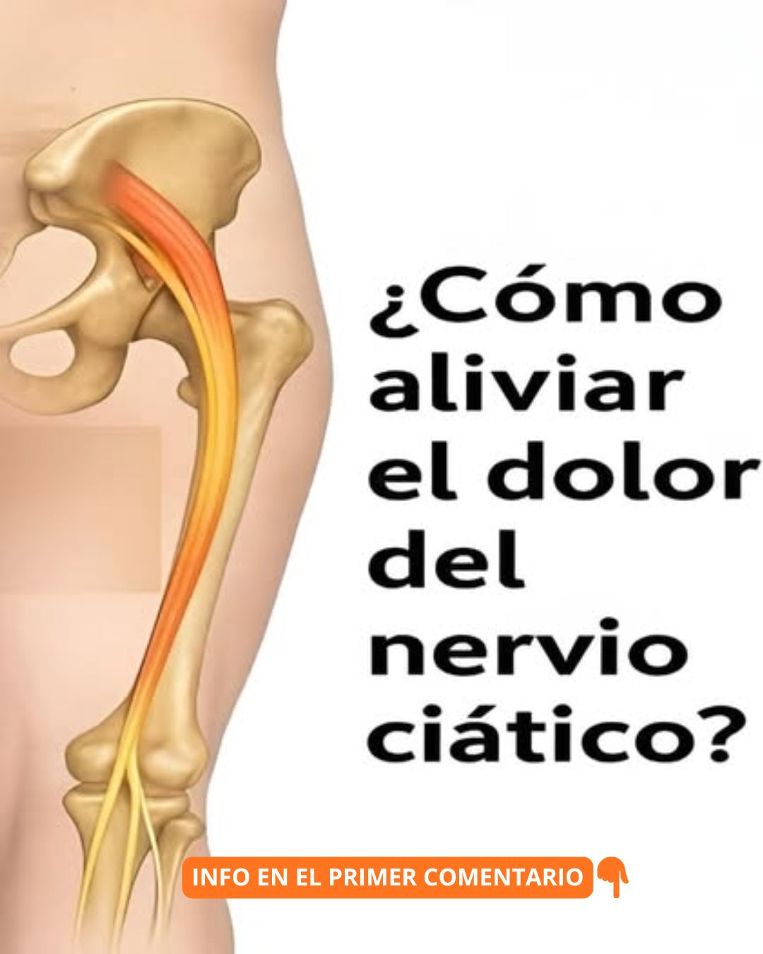 Ubicación del nervio ciático
